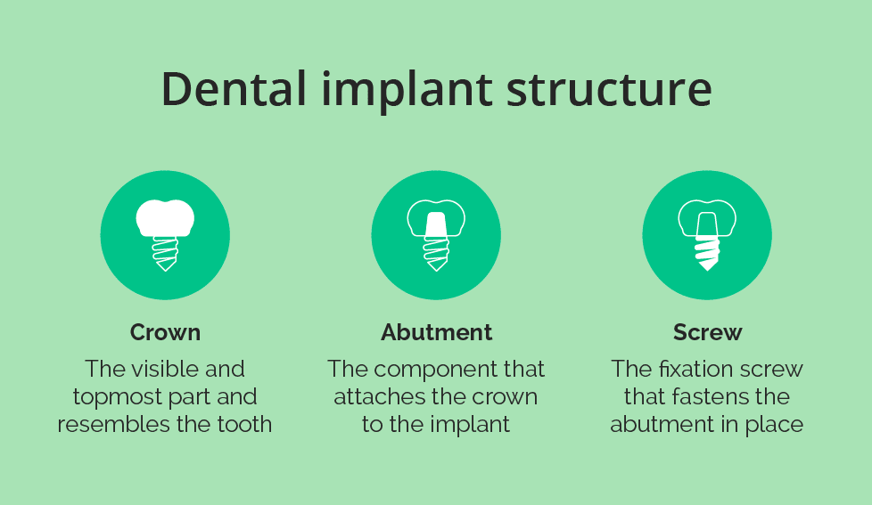 Illustration of the dental implant structure that determines dental implant cost